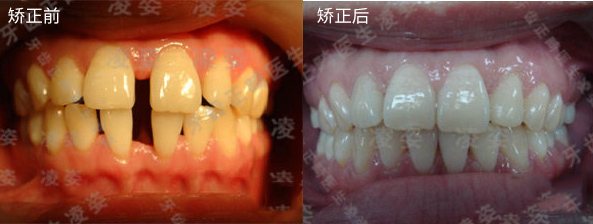 牙缝大怎么办？用上海圣贝口腔隐形矫正案例告诉你