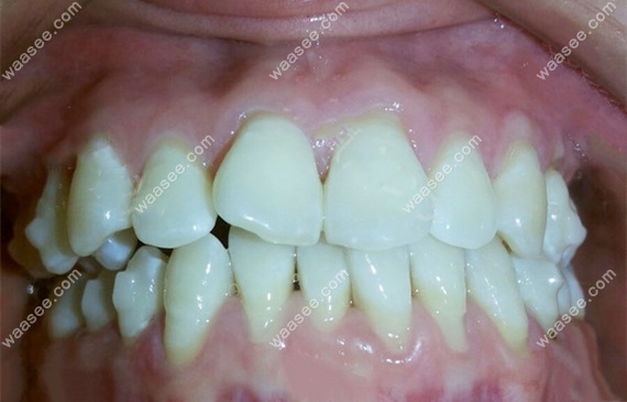 这是我在中诺口腔矫正牙齿6个月时候的效果