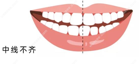 牙齿中线不齐需要矫正吗？答案是yes！