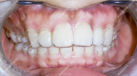 在中诺口腔矫正牙齿1年的效果图