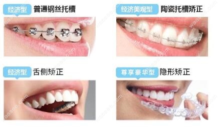 牙套的种类