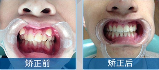 通过上海悦康口腔正畸案例了解正畸能解决哪些畸形牙问题