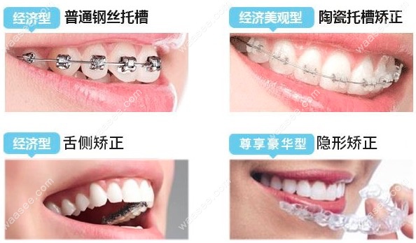 牙齿矫正的方法有哪些？.png