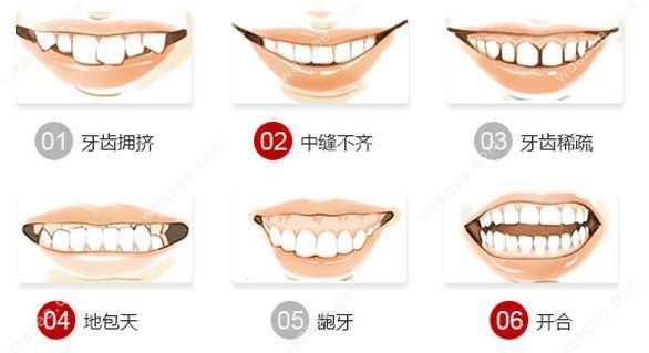 哪些牙齿问题需要牙齿矫正？.jpg