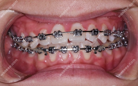 前牙反颌矫正1年的效果图