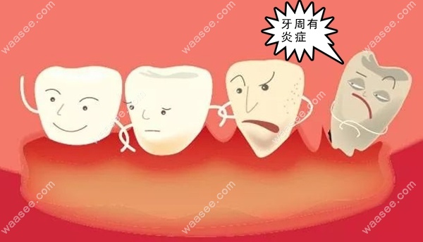 牙周炎是引起牙齿松动的主要原因