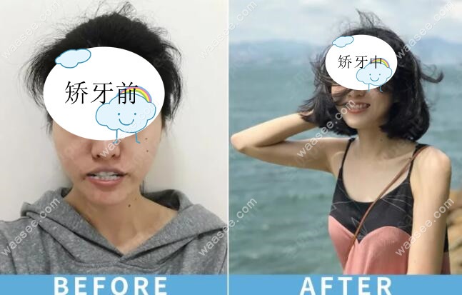 门牙歪斜的小姐姐矫正前后脸型对比照片