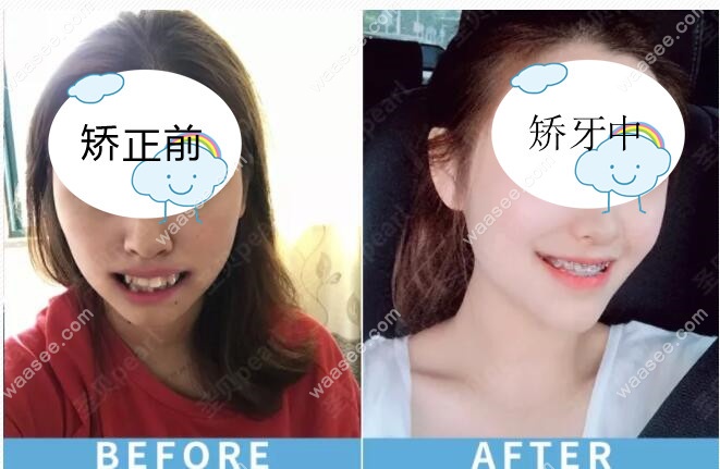 牙齿极度个性的龅牙小姐姐戴牙套矫正对比图