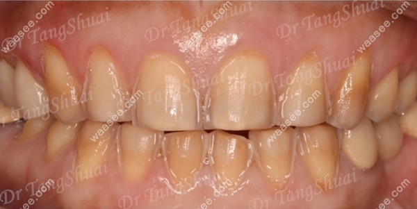 北京雅医家牙科做牙齿瓷贴面的修复效果术前照