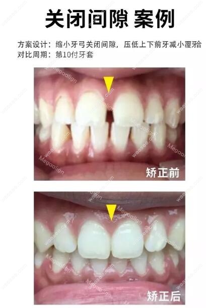 美加易齐隐形牙套关闭间隙案例