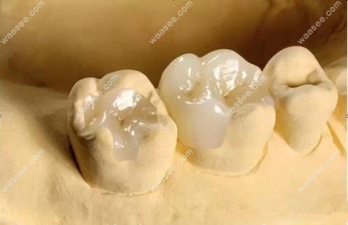 想做补牙必须了解日本幻彩纳米补牙与3M树脂的区别哟