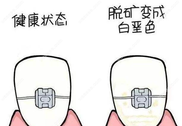 跪求小伙伴告知正畸期间牙齿矿化是怎么引起的该怎么办