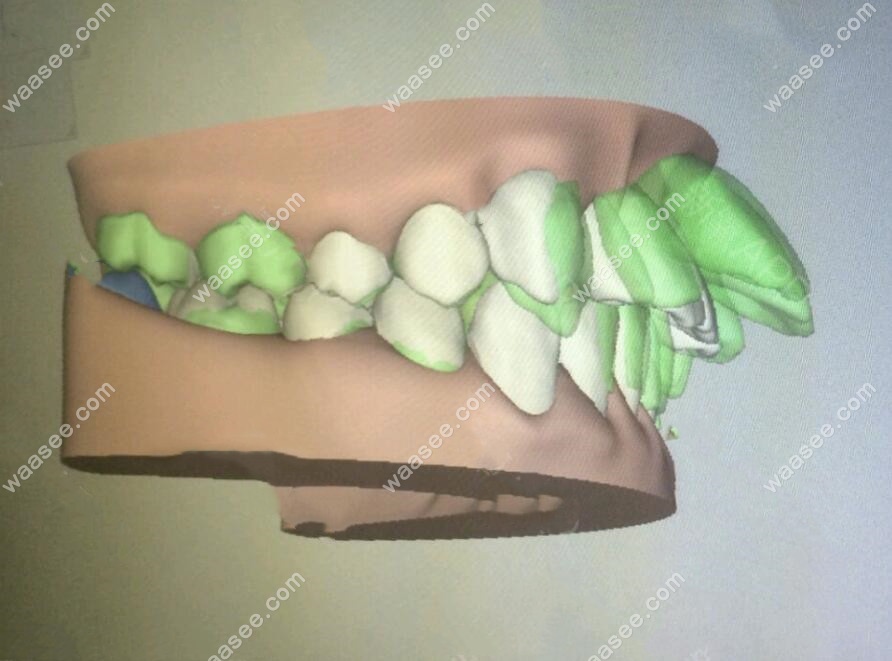 绿色是矫正前牙齿的位置图
