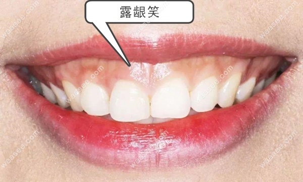 牙齿矫正配合牙龈整形术
