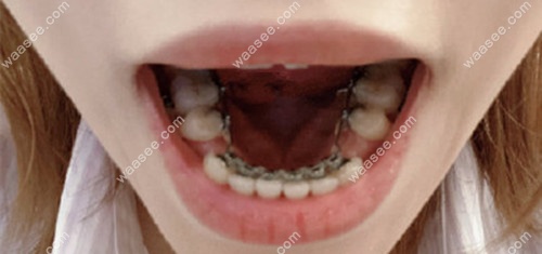 舌侧隐形牙套的托槽在内侧
