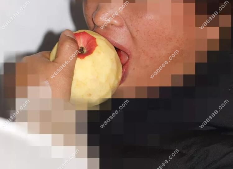 刚做完上半口种植牙，张姨就吃起了苹果
