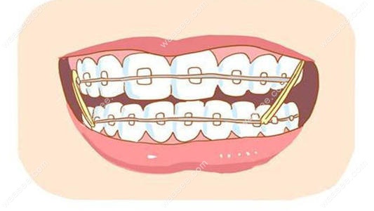 一篇文章为你解答戴牙套为何要后牙垫高,究竟有无副作用！