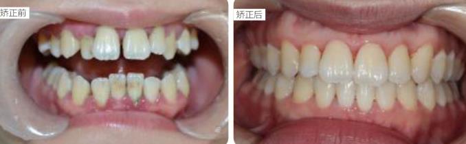 成人牙齿开颌做矫正效果也不错,附前后对比图哟