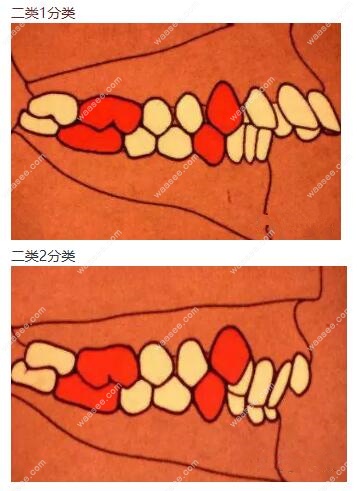 安氏Ⅱ类错颌畸形