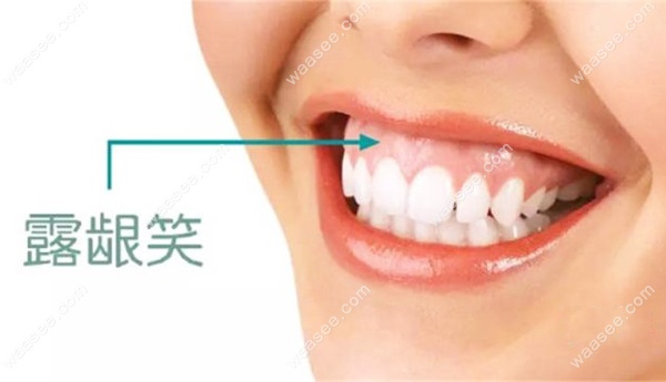 你想知道露龈笑的较佳治疗方式-水镭射牙龈整形要多少钱吗