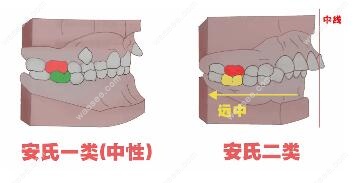 正畸安氏分类详解,对号入座你是一、二、三类错颌畸形哪类