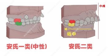 错颌畸形安氏分类