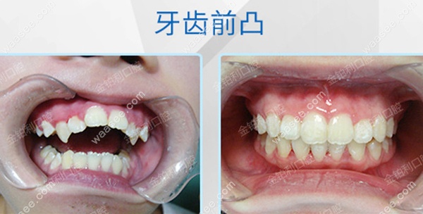 牙齿开颌伴前凸的正畸案例效果图