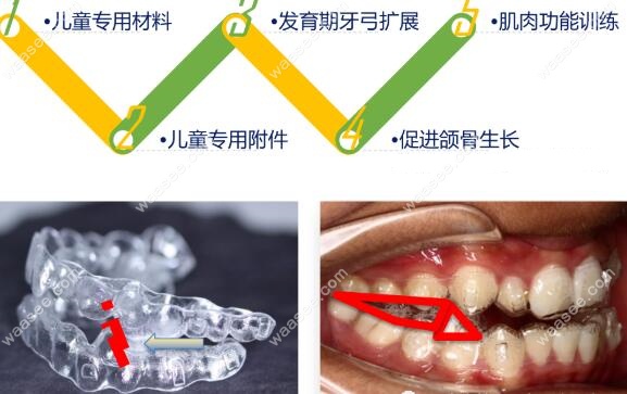 时代天使kid矫正器