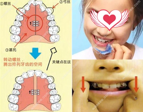 儿童活动矫治器