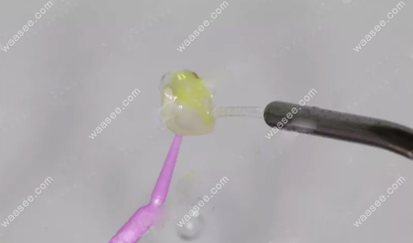 贴面修复体需要用清水冲洗