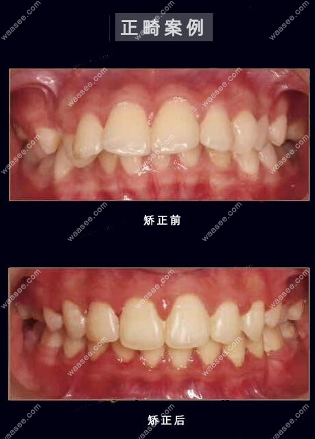 龅牙矫正后牙齿前后效果对比