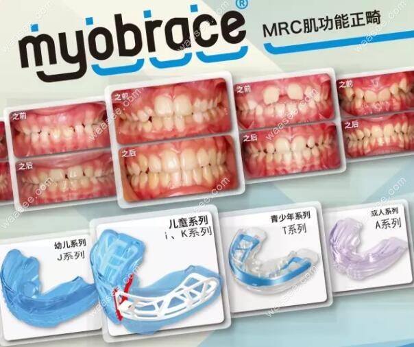 mrc肌功能矫正器型号
