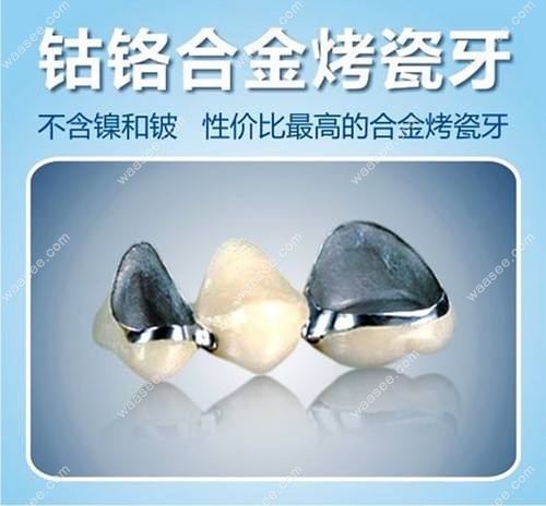 钴铬合金烤瓷牙