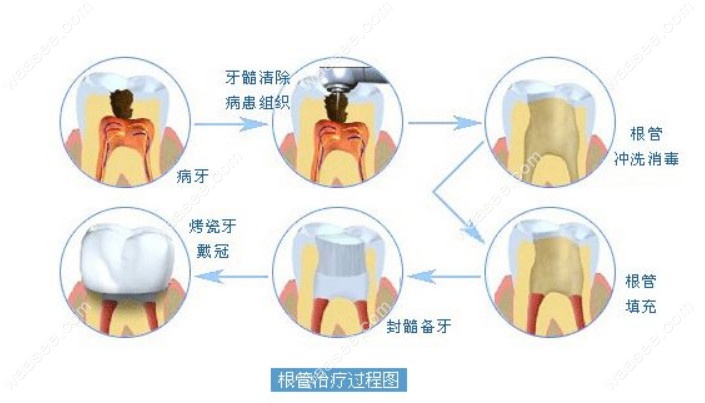 根管治疗