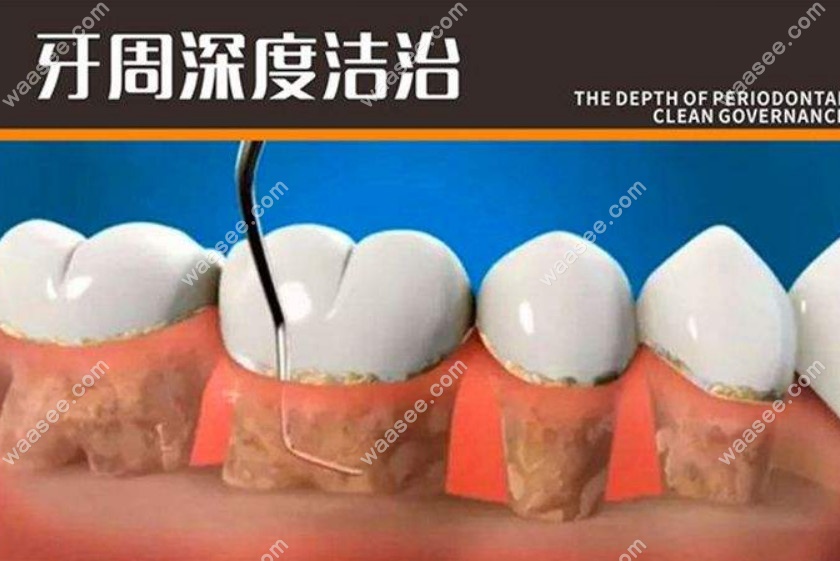 牙周治疗