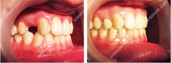 上颌单颗牙种植的前后效果图