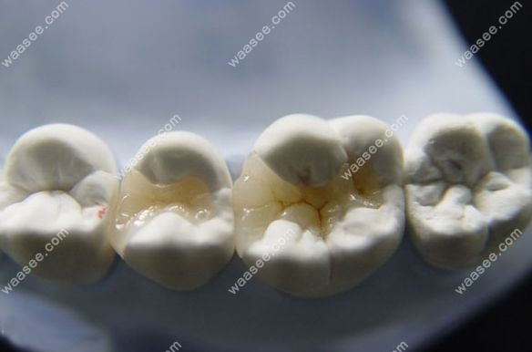 牙齿做嵌体修复一般多少钱一颗？和牙冠有啥区别？