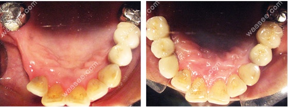  上颌无牙颌种植修复前后效果图