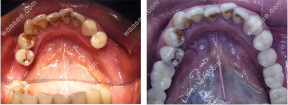 北京维嘉口腔的下颌多颗牙缺失的种植效果