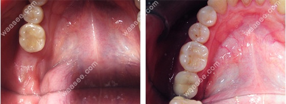 下颌磨牙缺失种植修复案例图