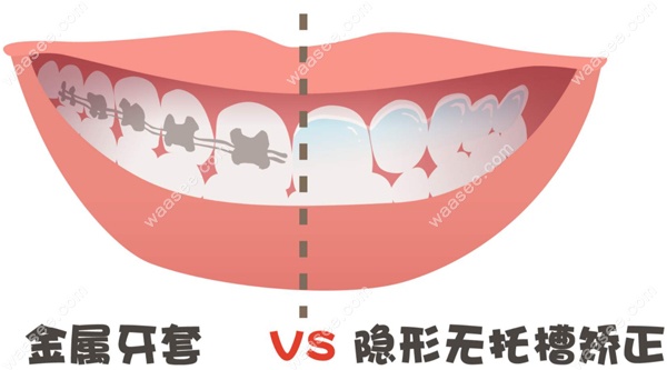 国产隐形牙套矫正的参考费用