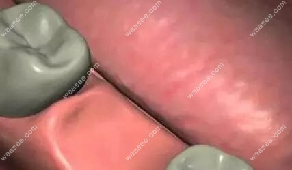 做种植牙之前做术前准备