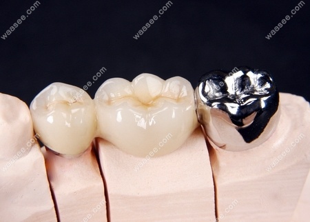 牙医科普纯钛金属牙冠的优缺点,附价格分享哦
