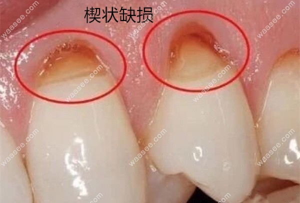牙齿楔状缺损轻微图片