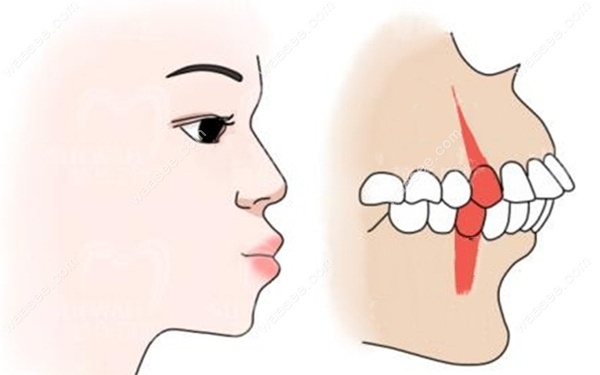 龅牙齿对嘴巴外观的影响