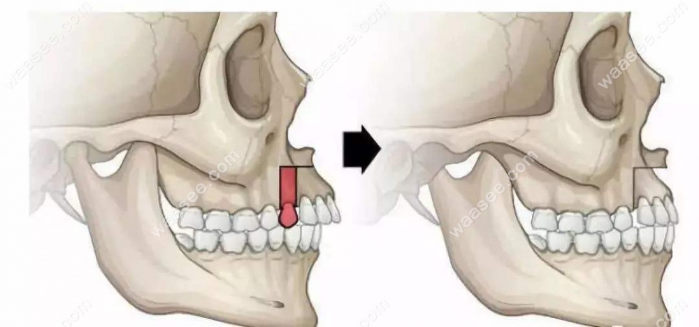 正颌手术前后对比
