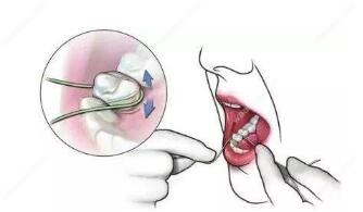牙周炎捆绑治疗