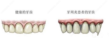 牙周炎与正常健康的牙齿对比