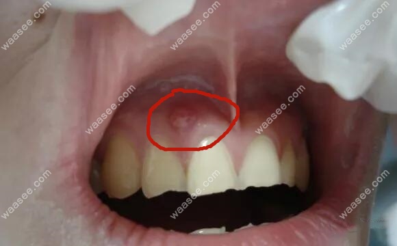 牙龈上长个脓包是怎么回事，这种牙龈鼓包怎么快速消除？