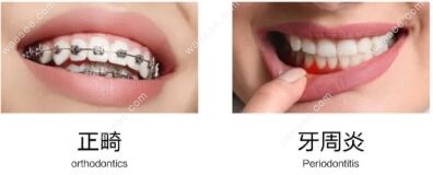 牙周炎矫正牙齿需谨记,不专业的正畸会导致牙齿松动风险